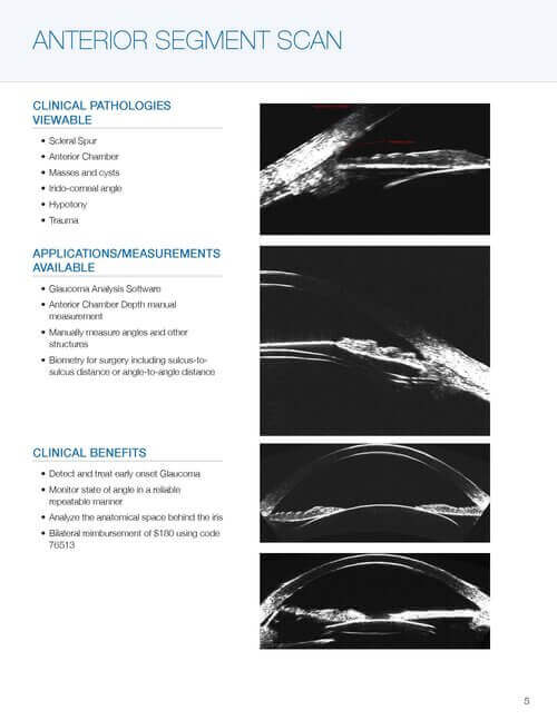 Anterior Segment Scan