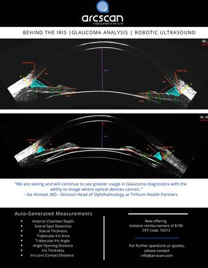 Glaucoma Brochure Single Sheet