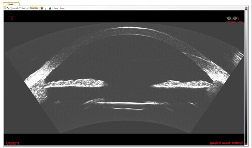 Image using the ArcScan Insight® 100 of a correctly implanted IOL