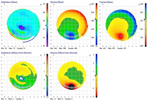 Keratoconus Map