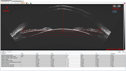 Pre-Operative ICL Scan with the ArcScan Insight® 100 Rapid Caliper Tool