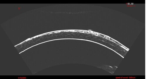 Image of patient’s corneal scar using the Insight 100’s Corneal Imaging Mode