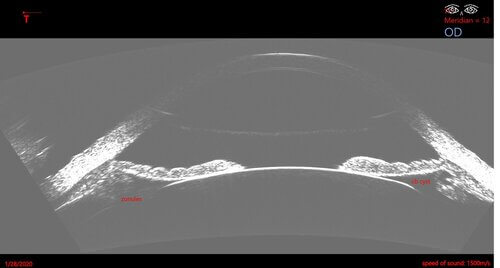 Image of a patient with glaucoma using the ArcScan Insight® 100. 