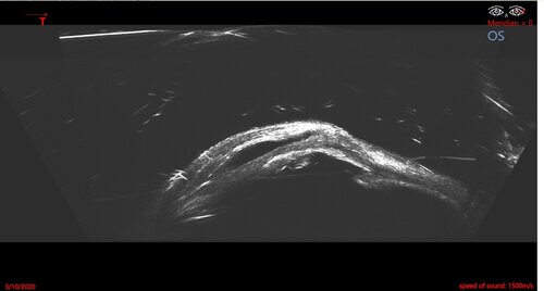 Image of a patient with malignant glaucoma using the Insight 100. ICD-10 Code: H40.83 malignant glaucoma; aqueous misdirection anterior scan type